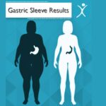 Gastric Sleeve Surgery