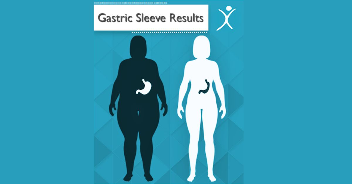 Gastric Sleeve Surgery