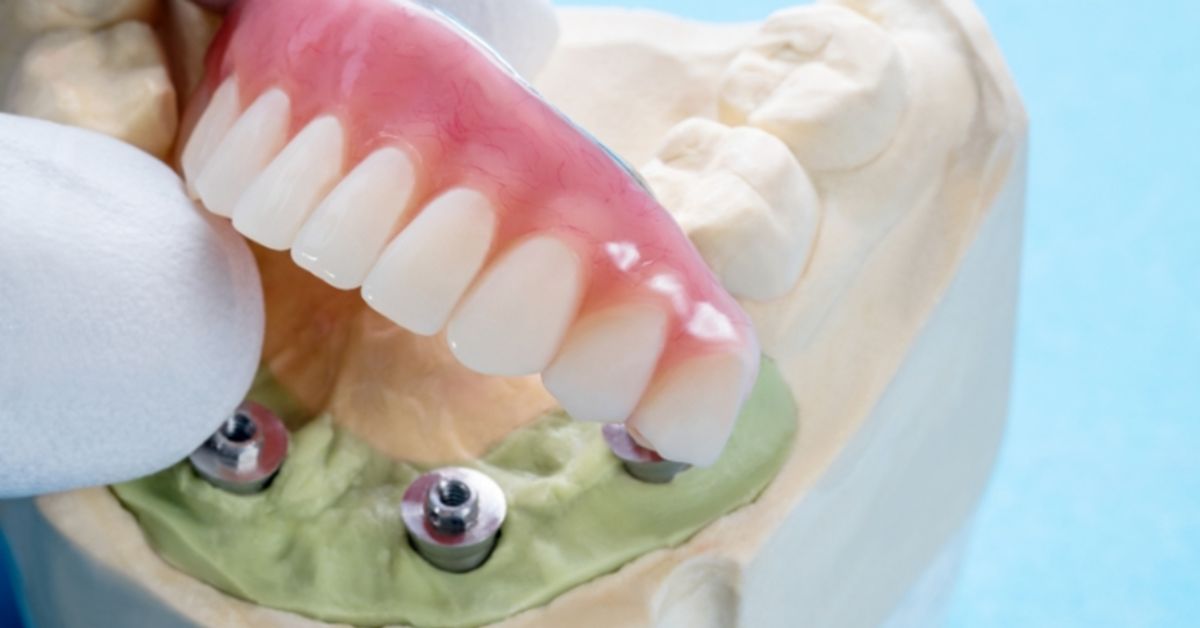 Dental Implants