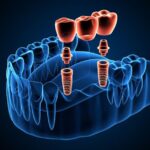 Custom Dental Crowns and Bridges