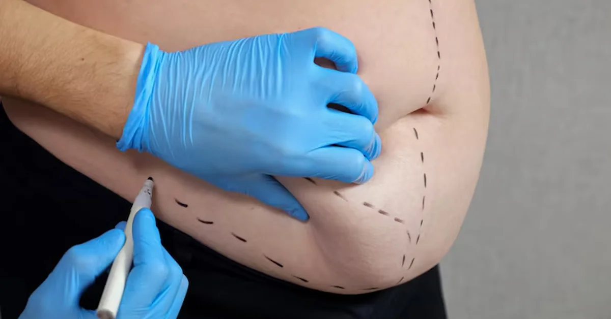 fat transfer cincinnati