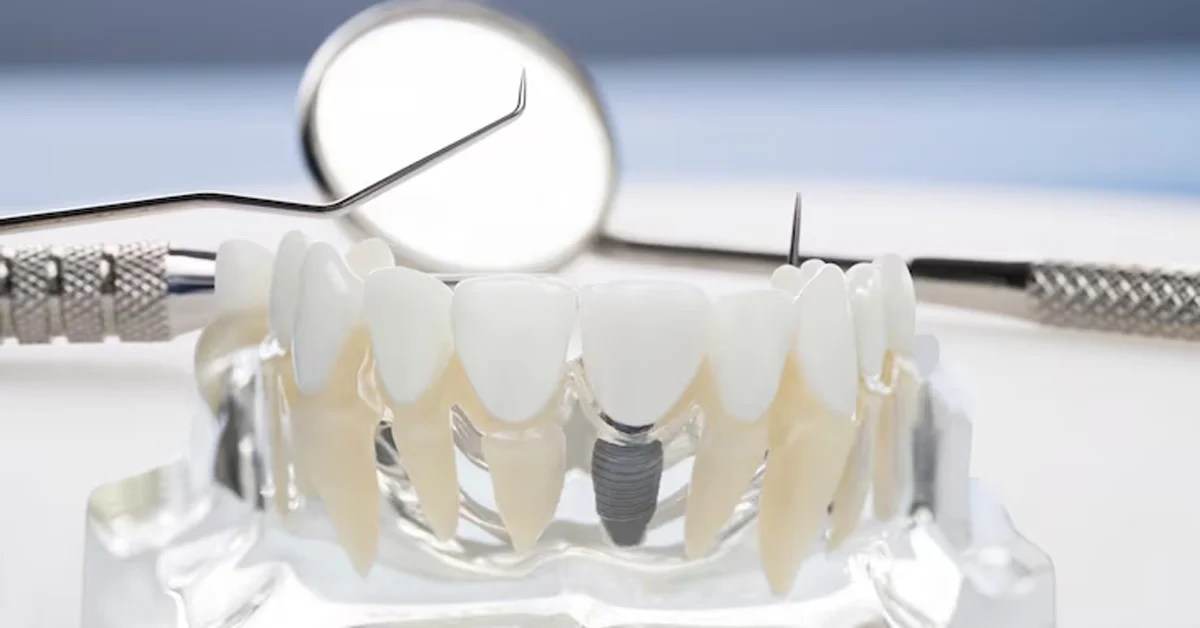 endosteal implant