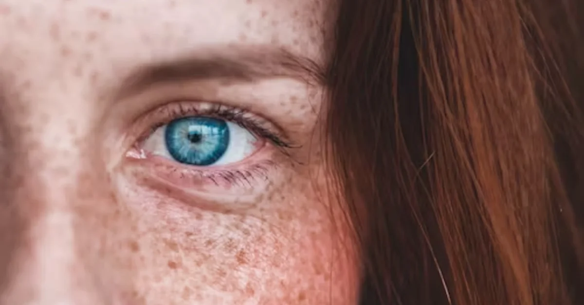 how to get rid of freckles