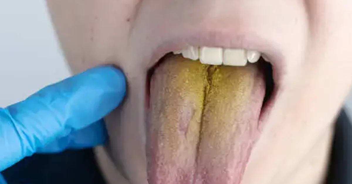 yellow roof of mouth