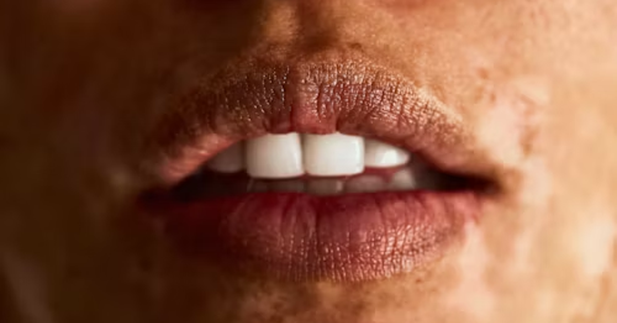 bullhorn lip lift